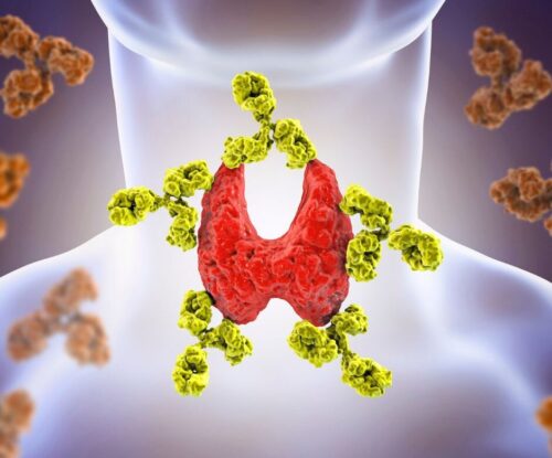 Grafika pokazująca zapalenie tarczycy