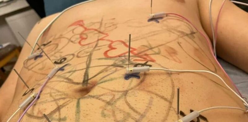 Zabieg elektroakupunktury