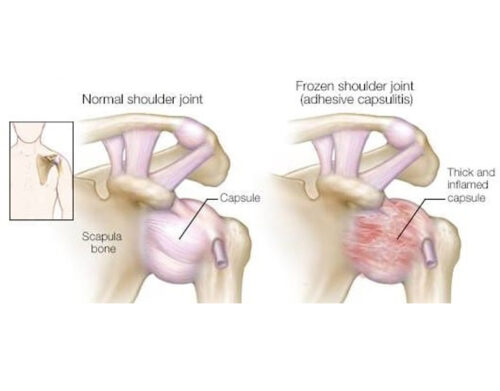 Anatomia zamrożonego barku