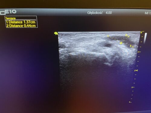 Ganglion diagnostyka USG