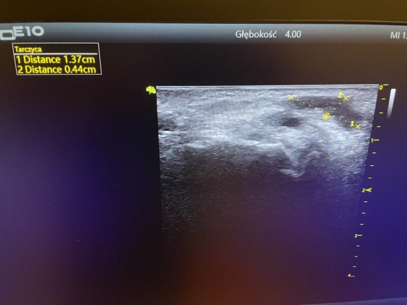 Ganglion diagnostyka USG