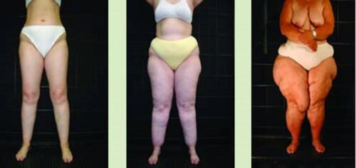 Trzy zdjęcia porównawcze nóg kobiet na czarnym tle, pokazujące stopnie zaawansowania lipedemy